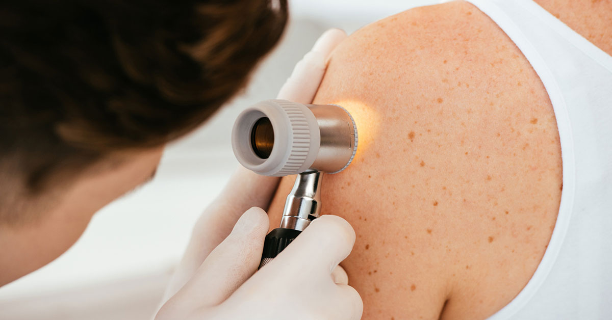 Melanoma Cancer Surgery