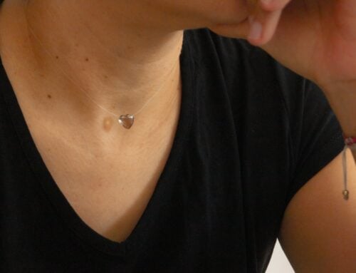 Very Early Inflammatory Breast Cancer Rash Signs